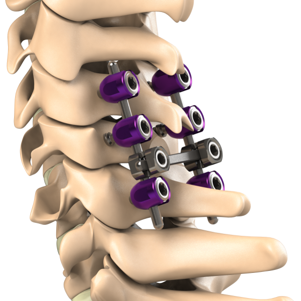 Posterior Cervical Rod – Kapa Care